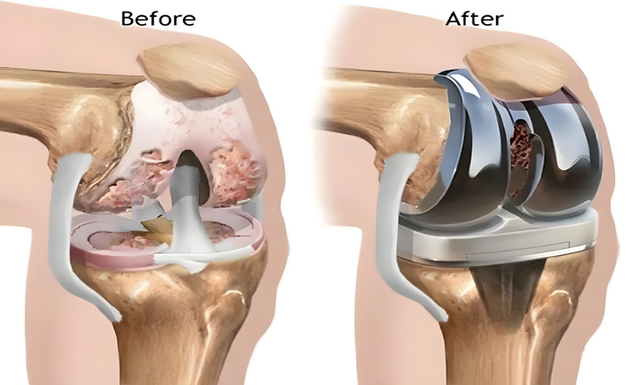total knee replacement